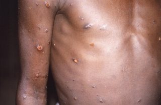  Variole du singe : comment diffère-t-elle de la variole humaine éradiquée il y a 40 ans ?