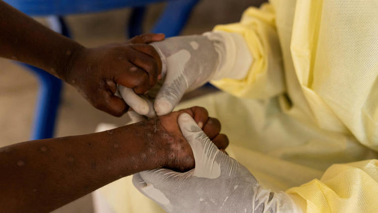 Mpox : 06 cas confirmés au Cameroun ! Actualité du Cameroun