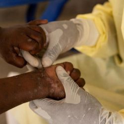 Mpox : 06 cas confirmés au Cameroun ! Actualité du Cameroun